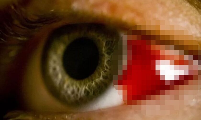 Νέος ιός εμφανίστηκε στην Ευρώπη - Κάνει τα μάτια να αιμορραγούν και κοστίζει τη ζωή στο 40% των ανθρώπων που μολύνει, λένε οι Τούρκοι